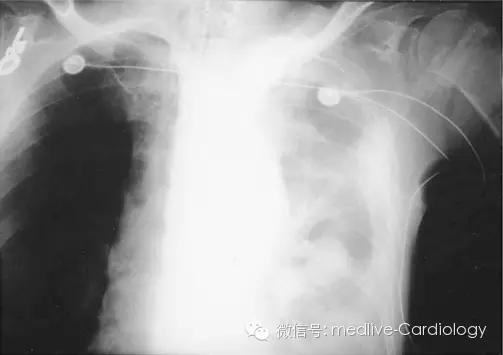 首页 医疗服务 大众医学  在诊断主动脉夹层的过程中,胸片常作为第一