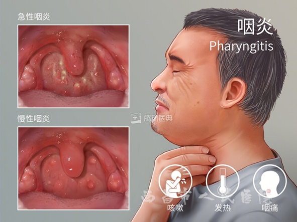 慢性咽炎防治小知识